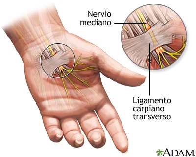 Sindrome túnel carpiano